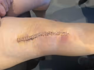 post surgery scars on knee