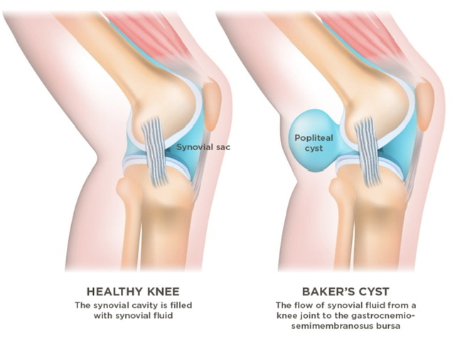 Medical diagram comparing healthy knee and Baker's cyst anatomy