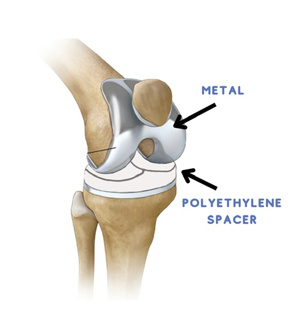 Anatomical diagram of knee joint replacement with metal and polyethylene components