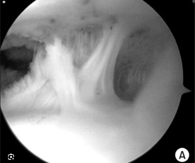 Black and white medical X-ray or radiographic image of joint or bone