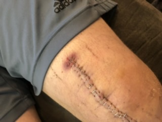 post surgery scars on knee