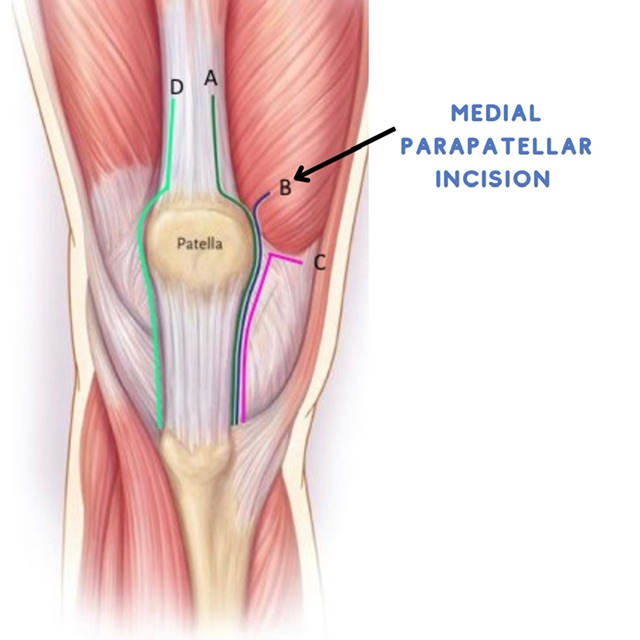 Anatomical diagram showing medial parapatellar incision on knee joint