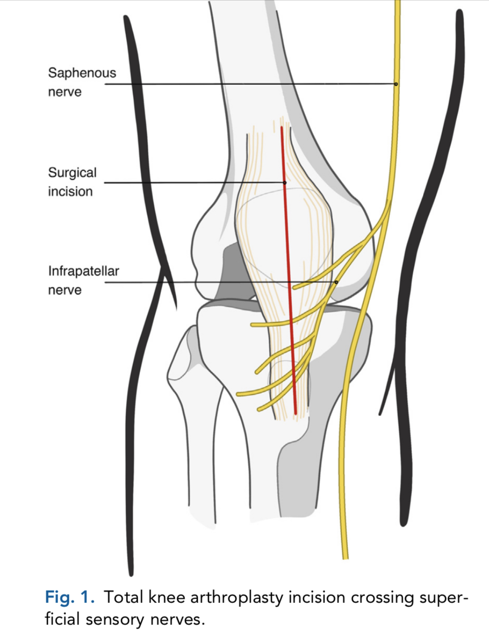 Anatomical diagram of knee surgery showing nerves and surgical incision