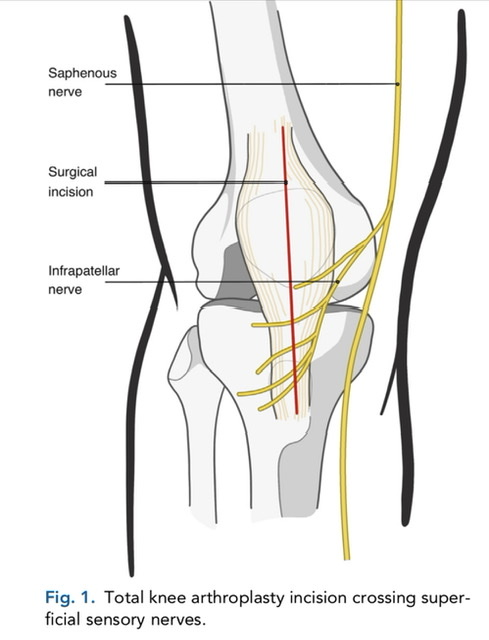 Anatomical diagram of knee showing surgical incision and nerve locations