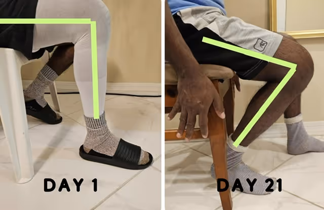 Leg recovery progress comparison showing improved mobility from Day 1 to Day 21