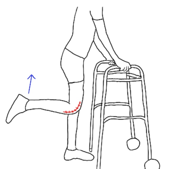 Person using walker with injured leg, mobility assistance diagram