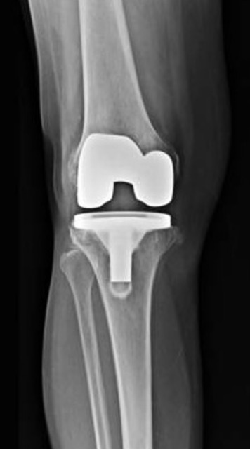 X-ray of knee joint showing total knee replacement prosthesis