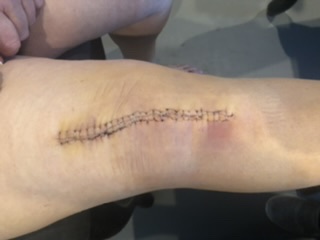 post surgery scars on knee