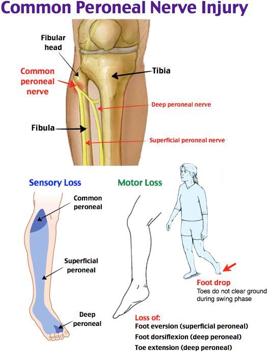 Diagram showing common peroneal nerve injury, sensory and motor loss effects