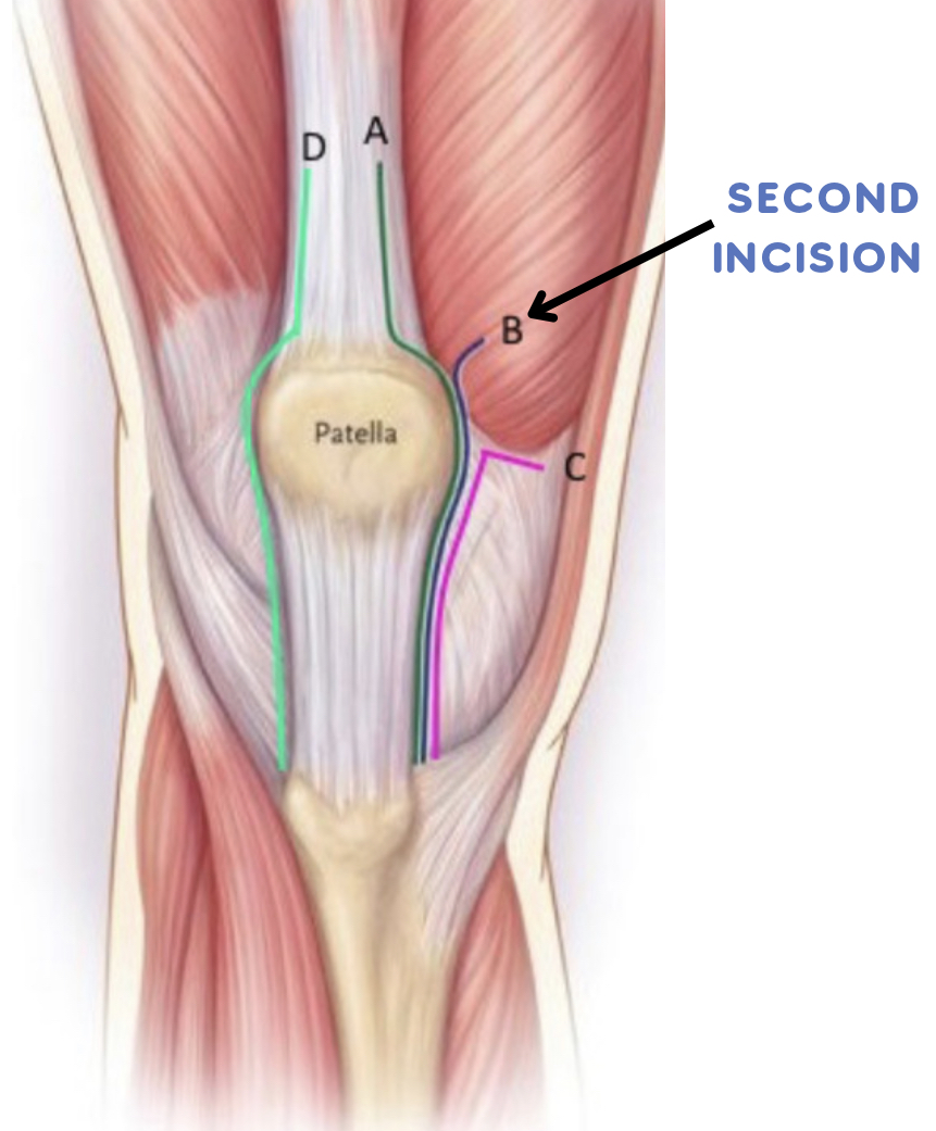 Anatomical diagram of knee showing patella and surgical incision points
