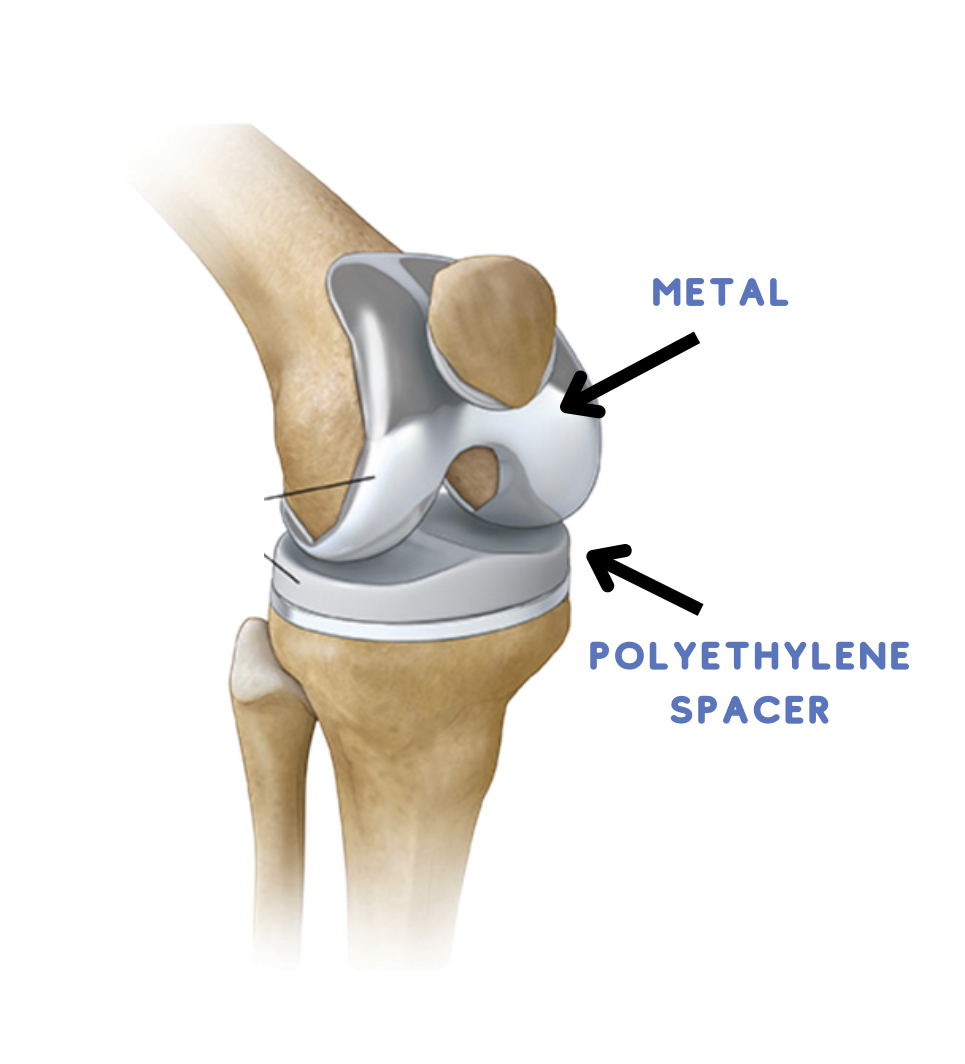 Anatomical diagram of knee joint with metal and polyethylene implant