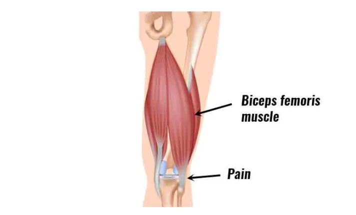 back of knee showing the hamstrings and biceps femoris tendon attachmentse