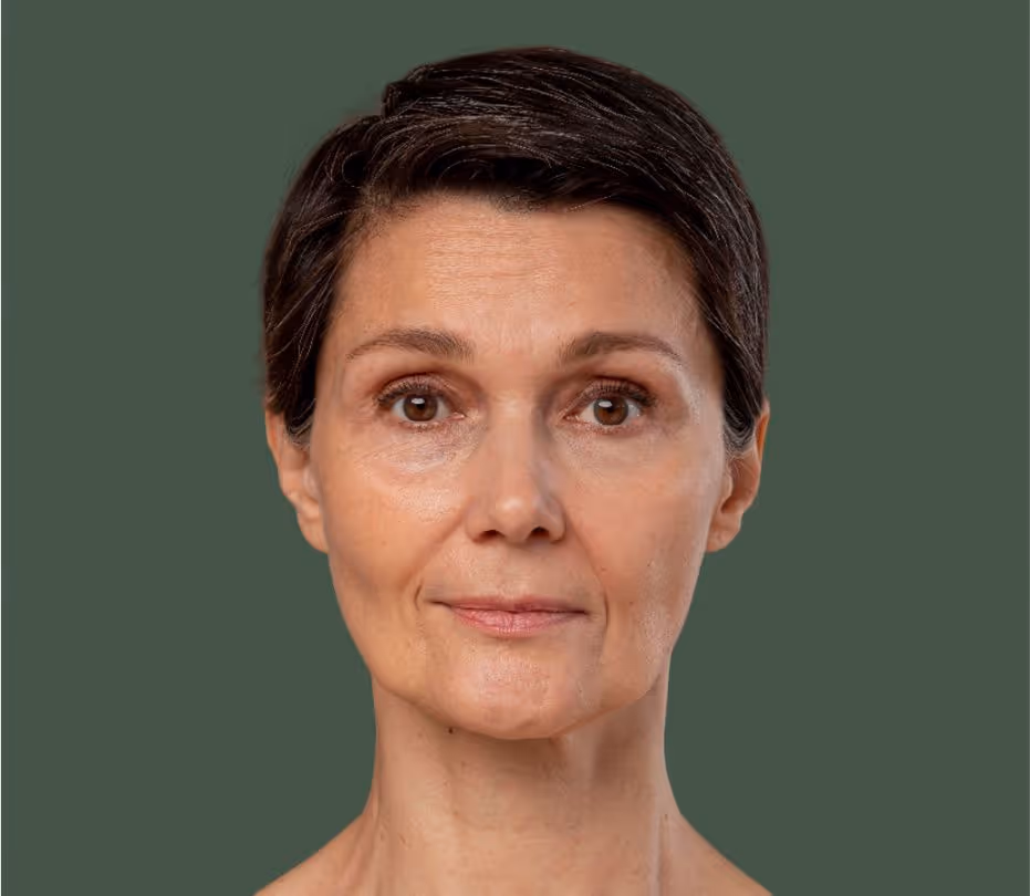 Rejuvenescimento facial com bioestimulador de colágeno