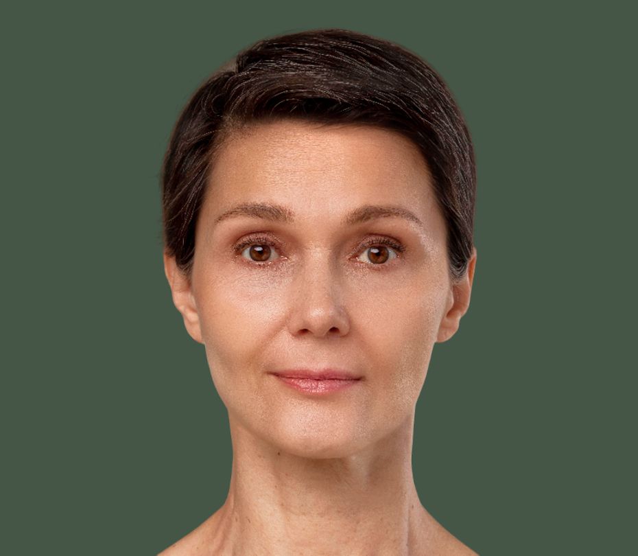 Rejuvenescimento facial com bioestimulador de colágeno