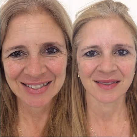 Antes e depois de um tratamento de Botox com técnica exclusiva.