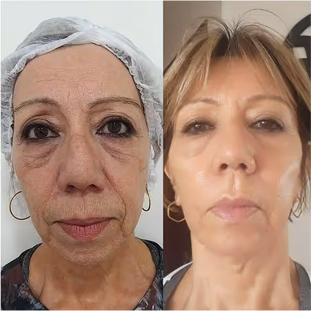Antes e depois de um tratamento de Bioestimulação de Colágeno e Elastina com técnica exclusiva.
