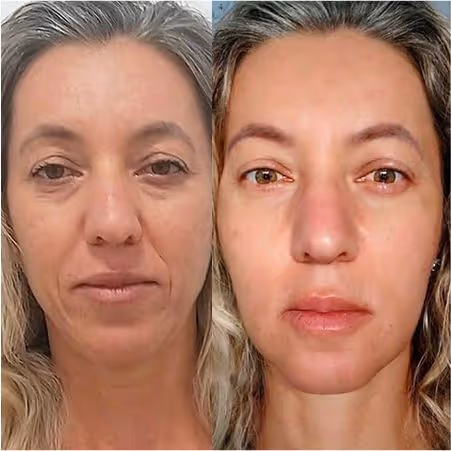 Antes e depois de um tratamento de Bioestimulação de Colágeno e Elastina com técnica exclusiva.