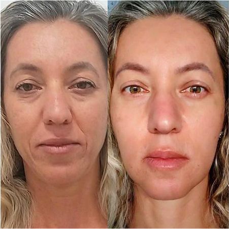 Antes e depois de um tratamento de Bioestimulação de Colágeno e Elastina com técnica exclusiva.