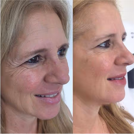 Antes e depois de um tratamento de Botox com técnica exclusiva.