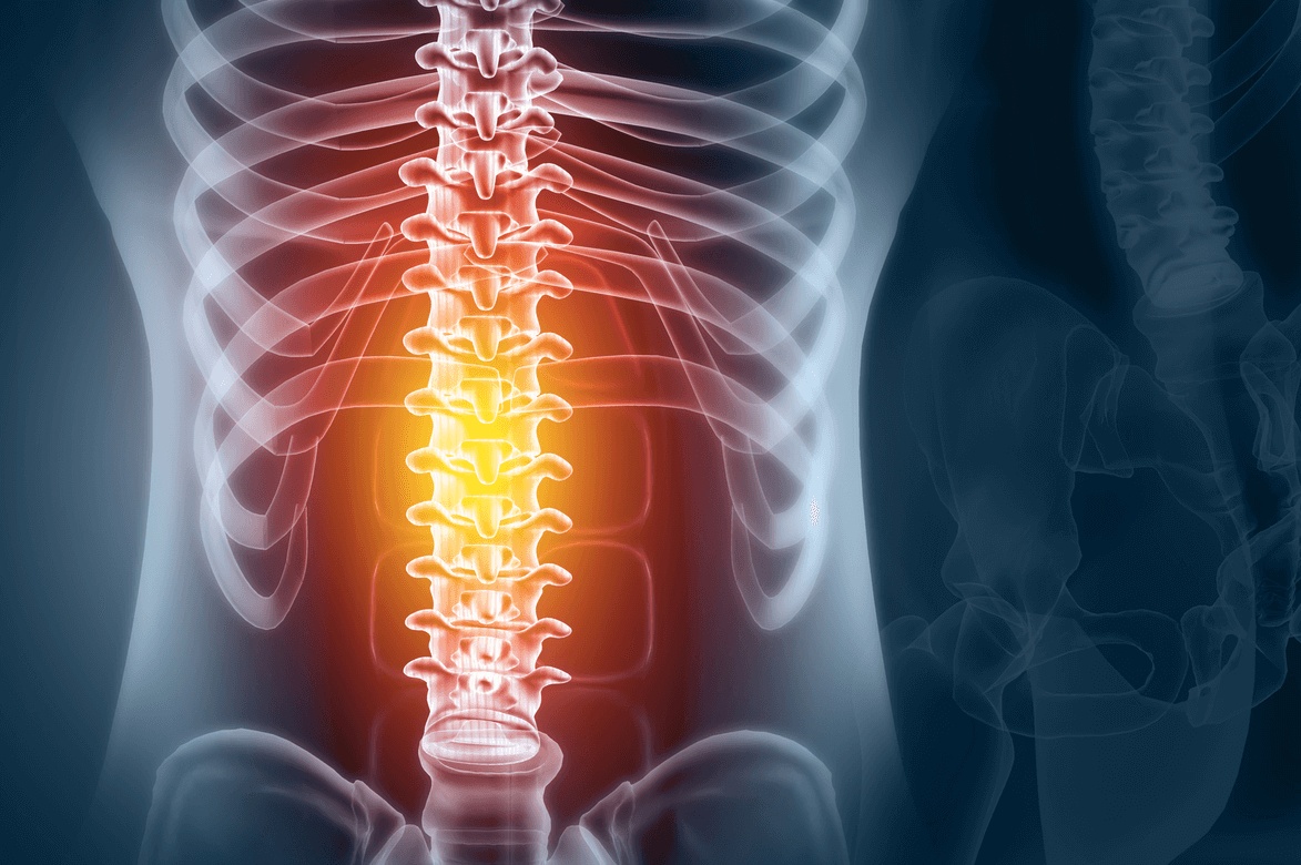 Illustration of an inflamed human spine and lower back highlighted in red, representing spinal pain or injury treated by the best spine surgeon in Los Angeles.