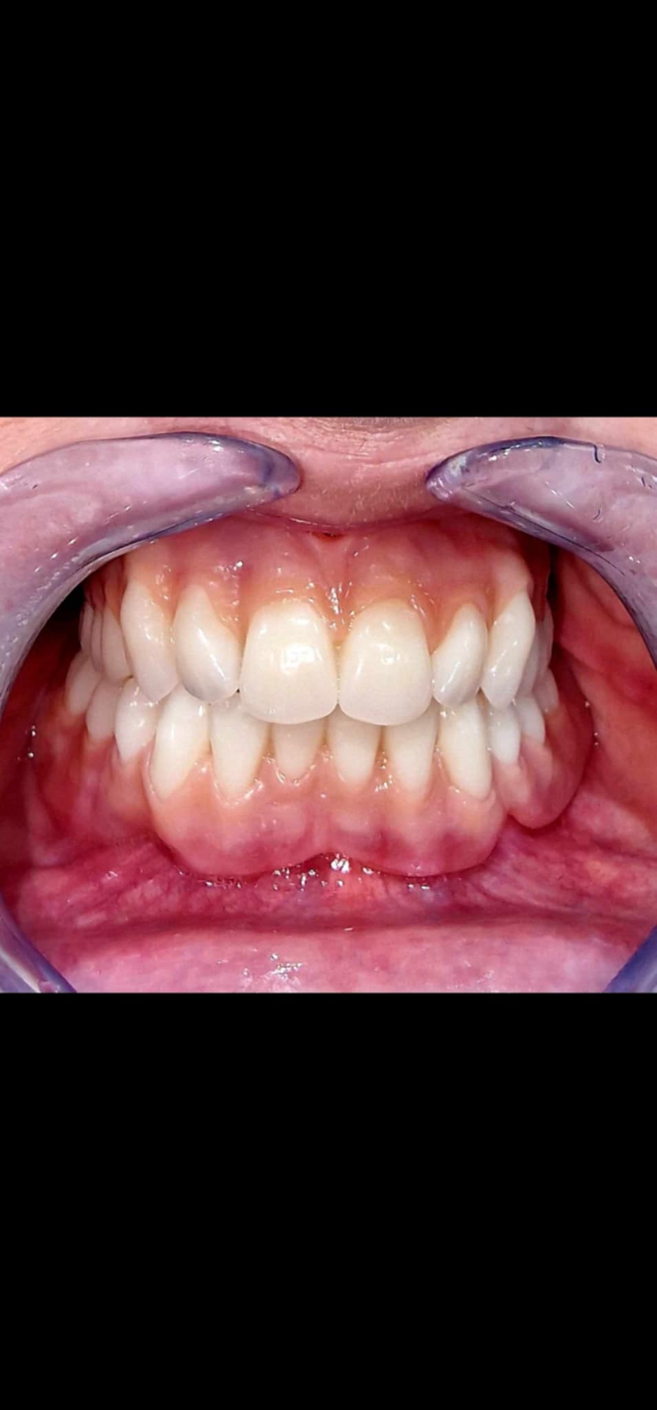 Full Dentures