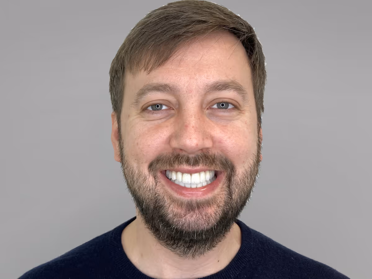 Nahaufnahme eines lächelnden Mannes mit braunem Haar und Bart vor einem grauen Hintergrund, welcher eine Veneers Behandlung erhalten hat.