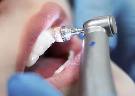 Zahnarzt reinigt Zähne mit rotierendem Bürstenaufsatz während einer professionellen Zahnreinigung.