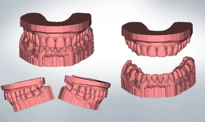 Beispielhafter 3D-Scan von oberen und unteren Zahnmodellen aus verschiedenen Blickwinkeln.