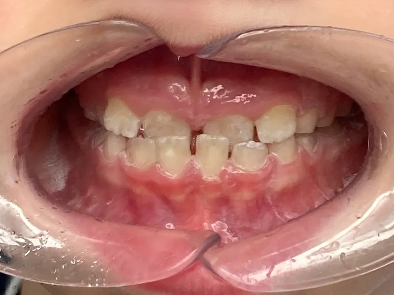 Frontale Nahaufnahme von Kinderzähnen mit Zahnspangenmundöffner, die unregelmäßig, schief und mit Lücken sind.