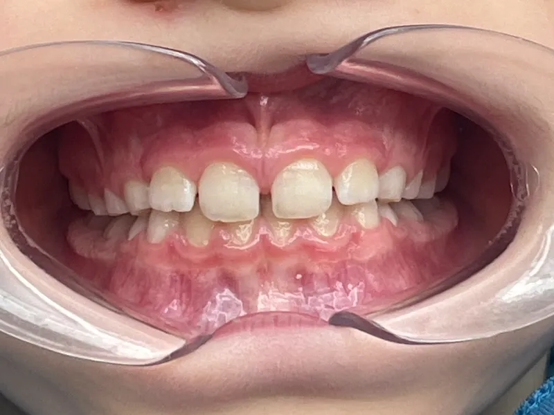 Frontale Nahaufnahme von Kinderzähnen mit Zahnspangenmundöffner, die sehr regelmäßig, gerade und mit kleineren Lücken sind.