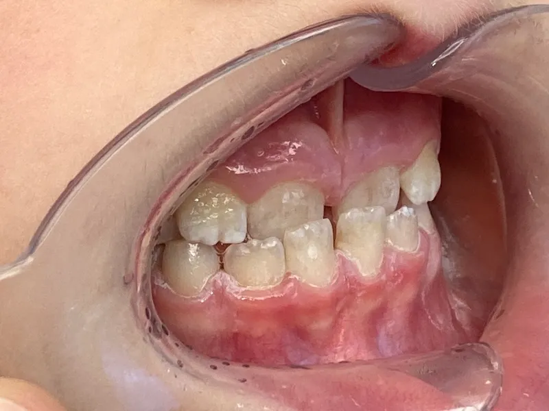 Seitliche Nahaufnahme von Kinderzähnen mit Zahnspangenmundöffner, die unregelmäßig, schief und mit Lücken sind.