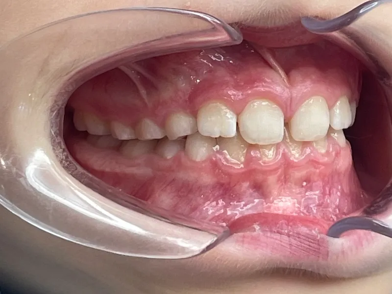 Seitliche Nahaufnahme von Kinderzähnen mit Zahnspangenmundöffner, die sehr regelmäßig, gerade und mit kleineren Lücken sind.