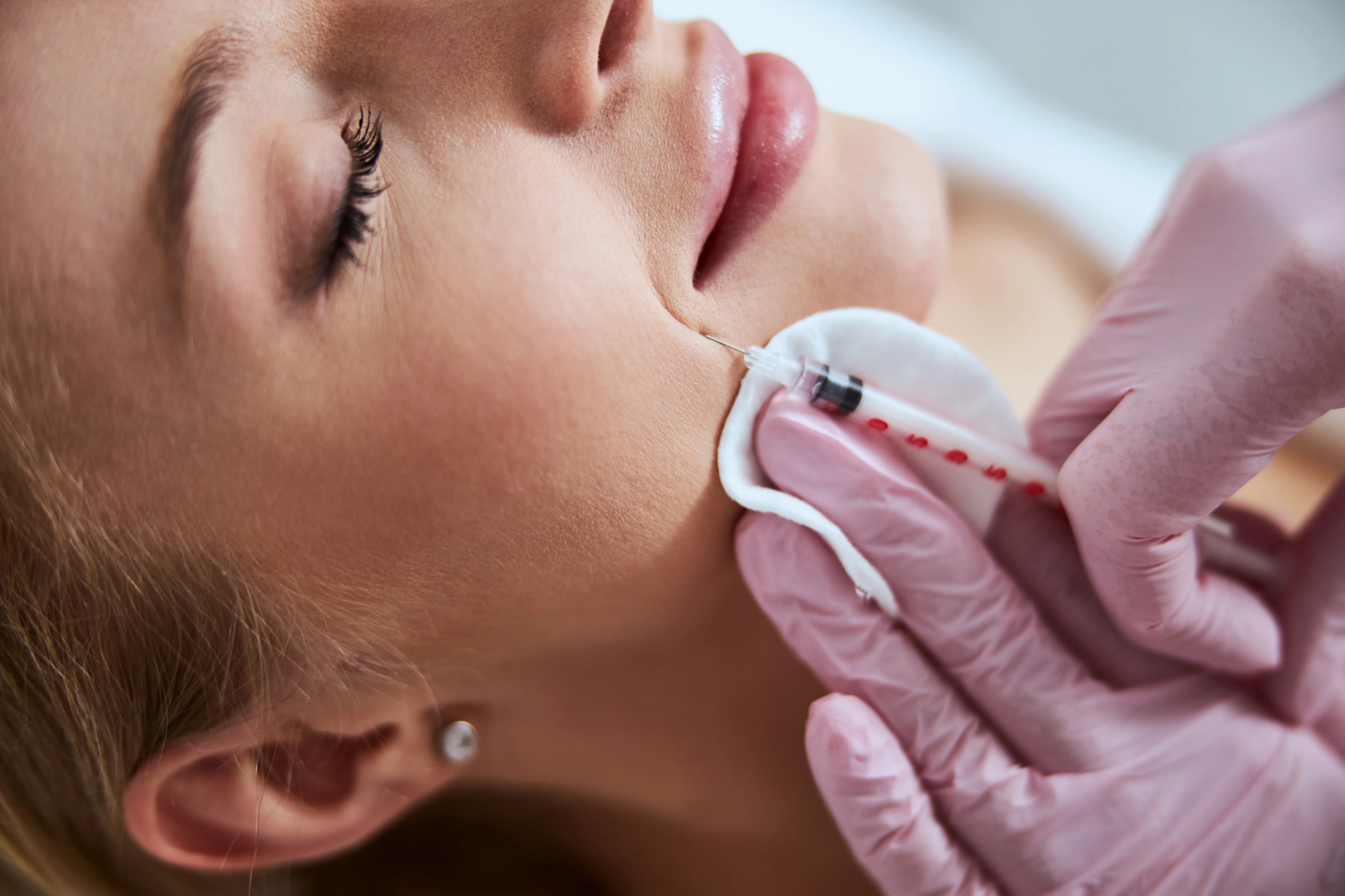 Efekt po aplikácii kyseliny hyalurónovej: čo očakávať