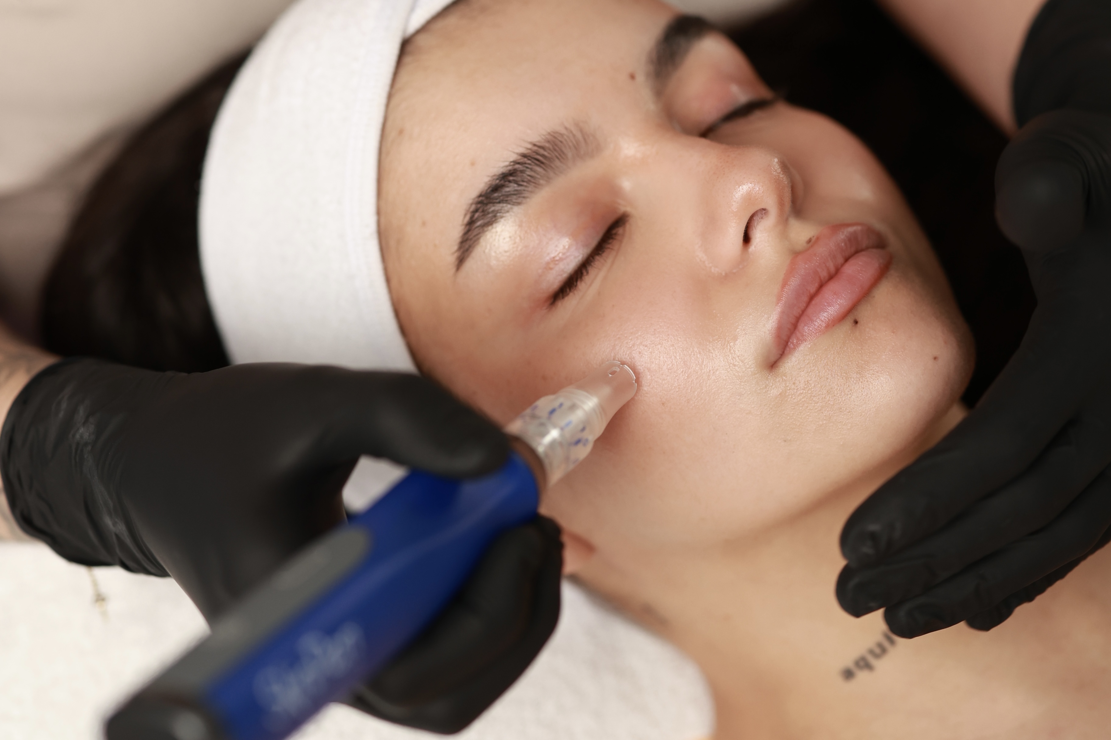 SkinPen® – Medicínsky microneedling pre regeneráciu a omladenie pokožky