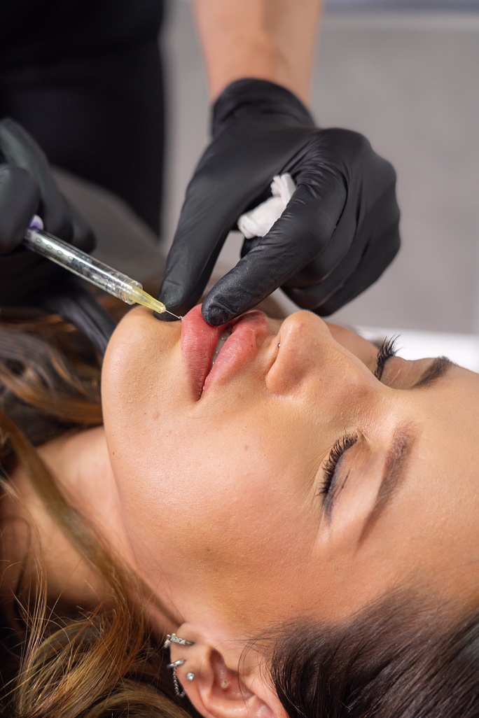 HydraLips – Mezoterapia pier pre hydratáciu a regeneráciu 