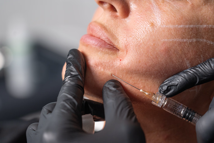 Sculptra® – Biosimulátor pre prirodzenú obnovu objemu a kolagénu