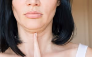 kybella for double chin in valrico