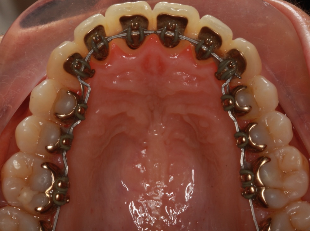 Lingual braces