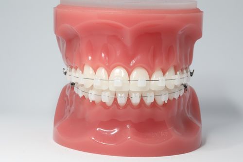 Clear ceramic braces