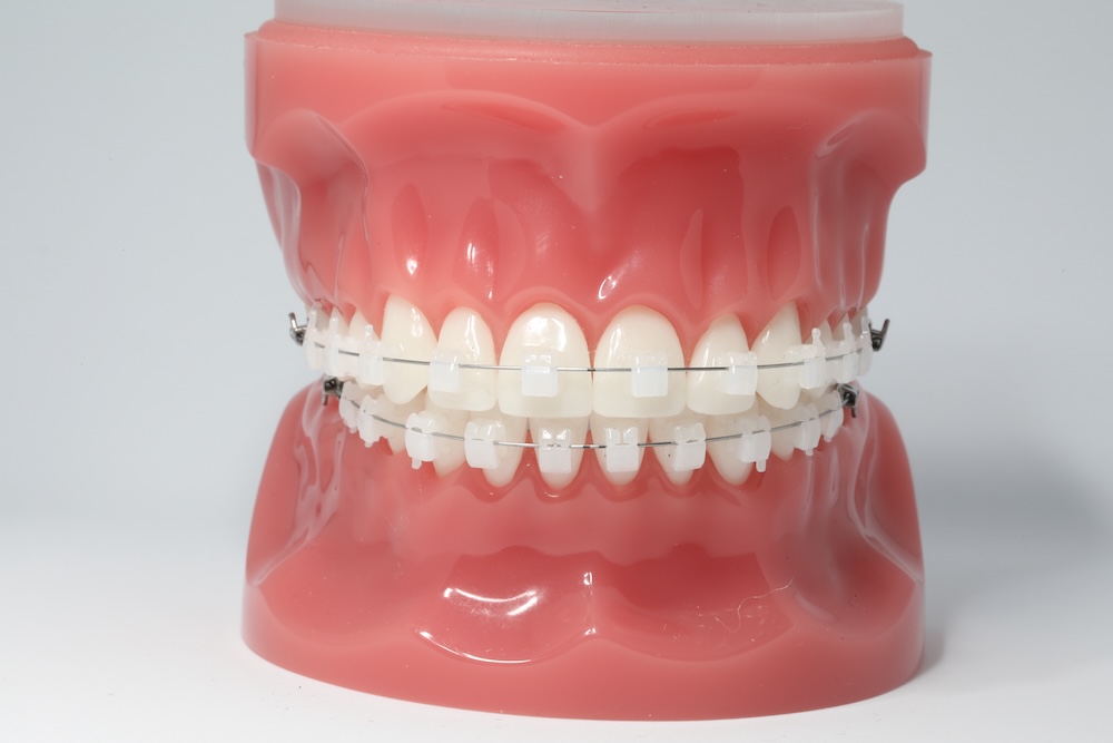 Clear ceramic braces