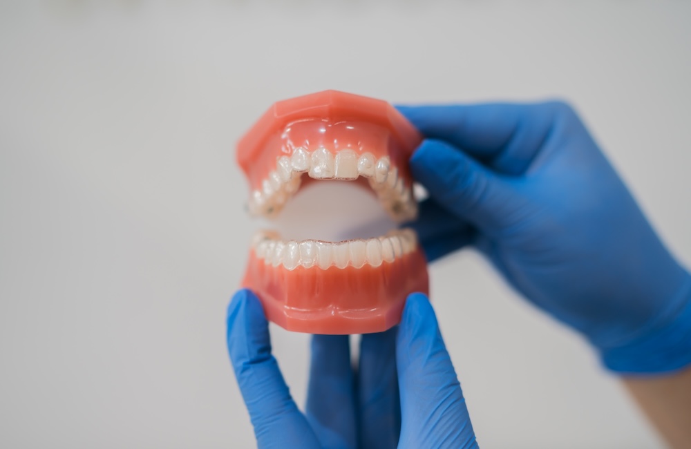Invisalign