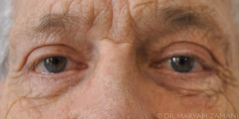 Close-up of an elderly person's eyes showing wrinkles and aged skin texture.