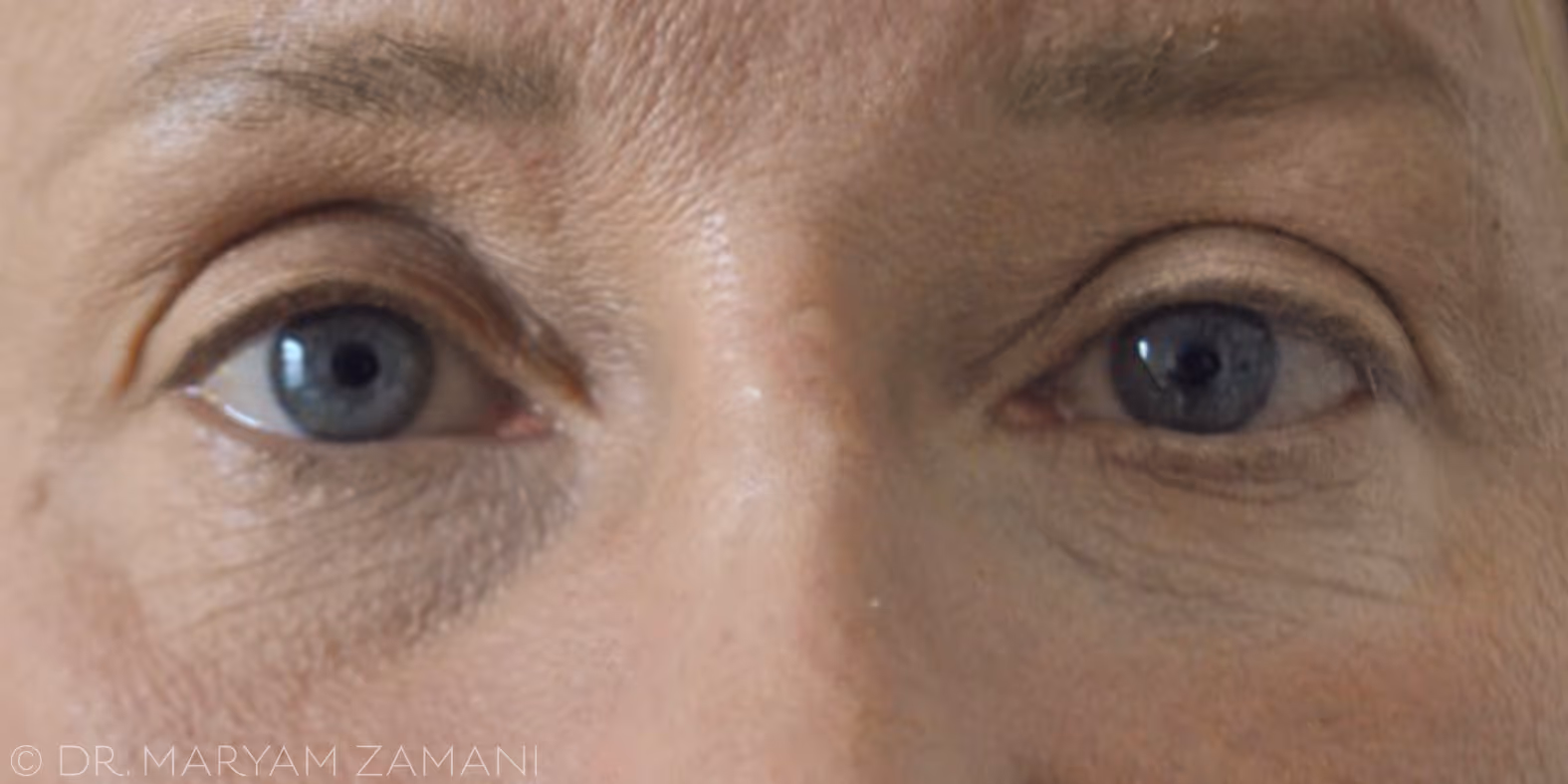 Close-up of a middle-aged person's blue eyes with visible skin texture and wrinkles around the eyes.