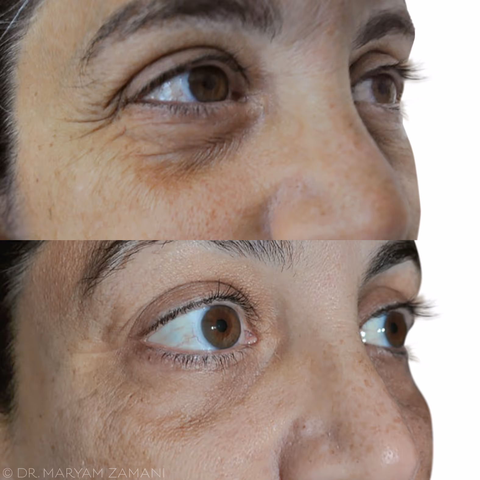 Close-up before and after comparison of a person's eye area showing reduced wrinkles and smoother skin in the after image.