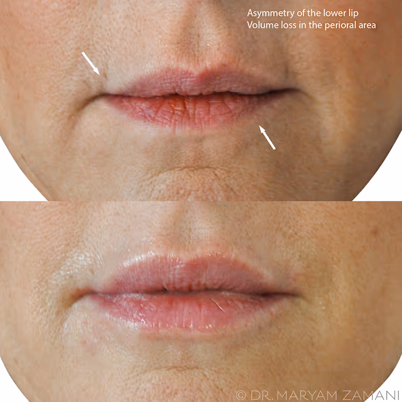 Comparison of lower lip showing asymmetry and volume loss before and after treatment for perioral area.