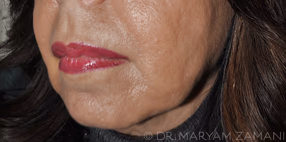 Close-up of the lower face of a person with smooth skin and bright pink lipstick, showing the jawline and chin.