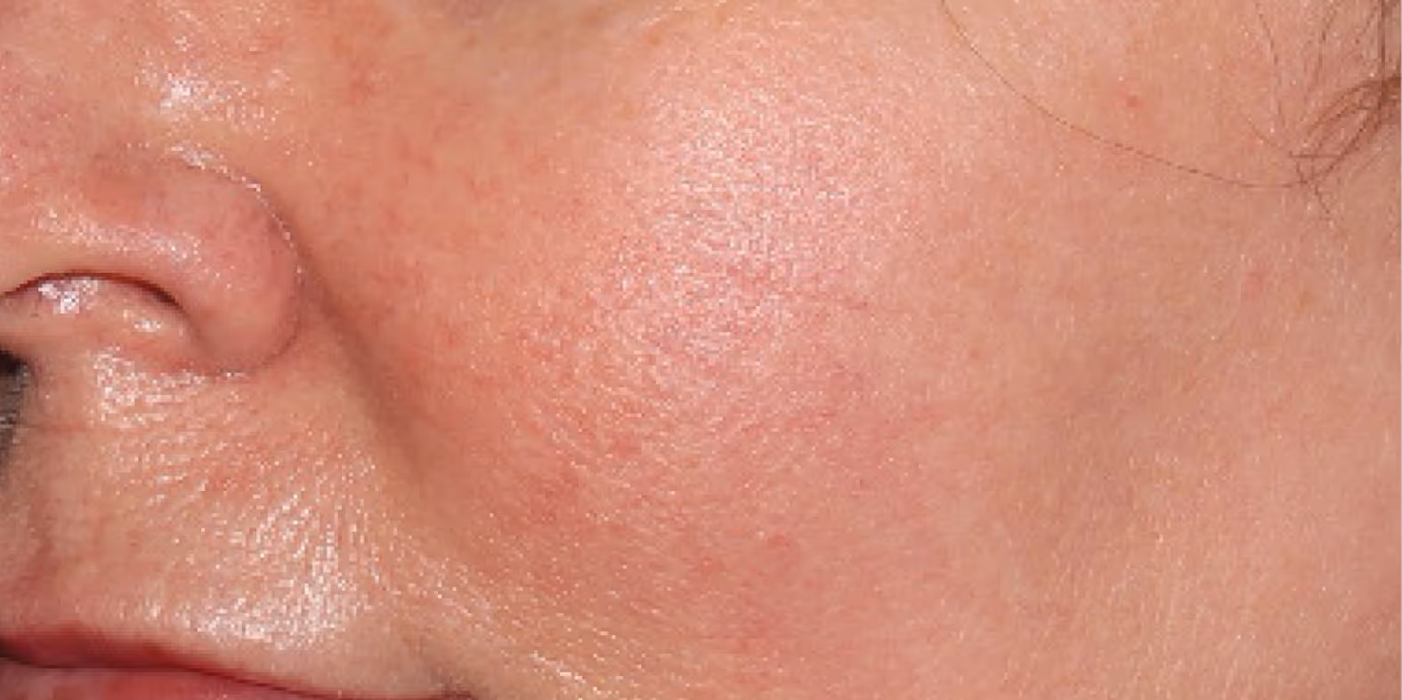 Close-up of a person's cheek and nose showing oily skin with some redness and uneven texture.