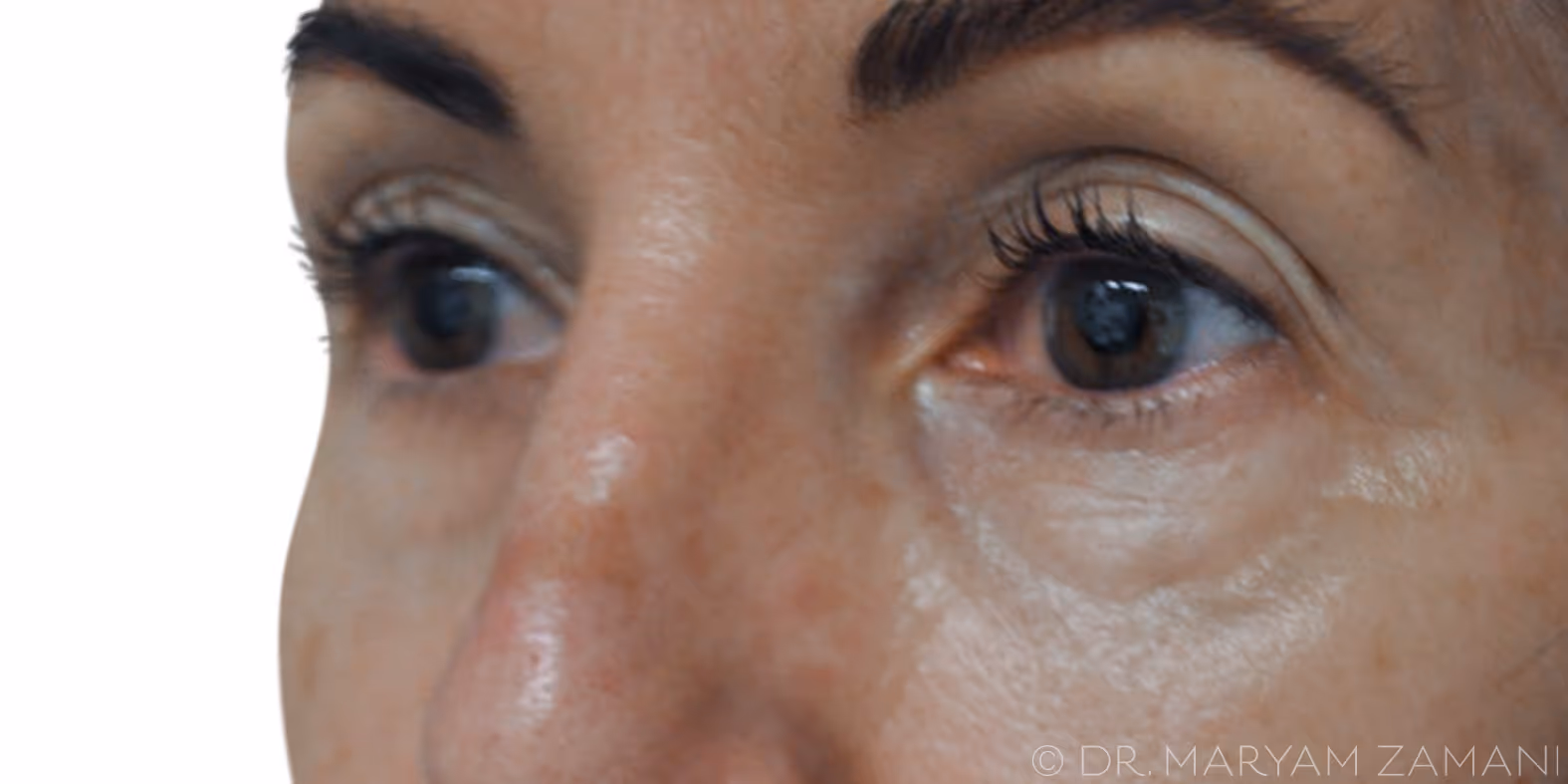 Close-up of a person's face focusing on brown eyes and smooth skin with light wrinkles around the eyes.
