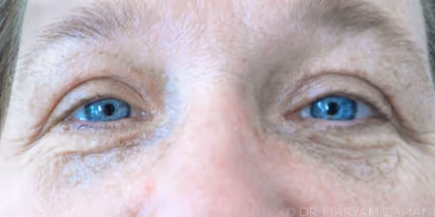 Close-up of a person's blue eyes and the surrounding skin showing natural wrinkles and texture.