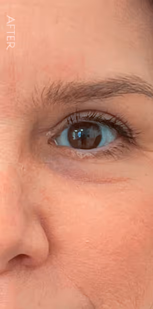 Close-up of the right eye and surrounding skin of a person showing smooth skin texture and minimal wrinkles, labeled 'AFTER'.